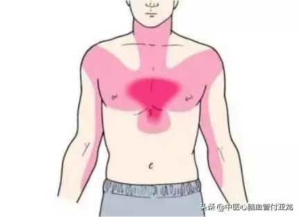 心绞痛的最新分型研究文章